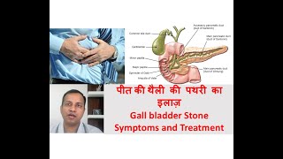 Gall bladder stone symptoms treatment in Hindi By Dr Vikas Singla [upl. by Bayly]