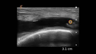 Knee Effusion Ultrasound Image Interpretation [upl. by Denie]