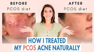 How I Healed My Cystic Acne NATURALLY PCOS amp Hormonal Acne [upl. by Hada]