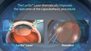 Blade versus Bladeless LASIK [upl. by Iran]