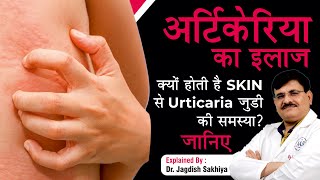 Urticaria Hives Causes Symptoms amp Treatment  In Hindi   Dr Jagdish Sakhiya Skin Clinic [upl. by Hoffarth351]