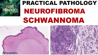 NEUROFIBROMA AND SCHWANNOMA Clinical features amp Morphology [upl. by Kedezihclem]