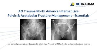 Acetabular Fracture Associated BOTH Columns  Everything You Need To Know  Dr Nabil Ebraheim [upl. by Aleksandr]