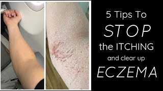 HEALING ECZEMA  5 Things I Do Each Day To STOP THE ITCH [upl. by Assina]