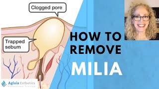 HOW TO REMOVE A MILIA STEP BY STEP  NATURALLY [upl. by Asylem]