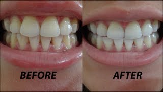 Crest 3D Whitestrips Vivid Before amp After Demo  Review [upl. by Atnuahsal]