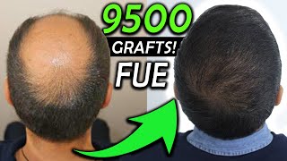 Kay´s 9500 Graft FUE Hair Transplant Transformation NW 6 [upl. by Nahtanaoj]