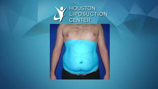 Liposuction for Men  Liposuction Before amp After [upl. by Micaela]