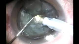 Stop and Flip A New Phacoemulsification Technique  Supplementary video ID 241811 [upl. by Atinet788]