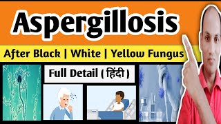 Aspergillosis  Symptoms  Treatment  Hindi  Kishor Sir [upl. by Aina778]