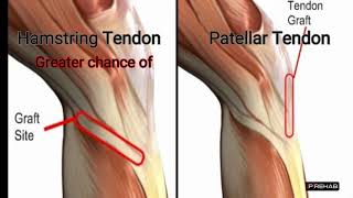 ACL Reconstruction Graft Options [upl. by Shult]