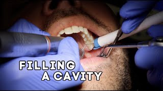 How Does A Dentist Fill A Cavity [upl. by Pisarik]