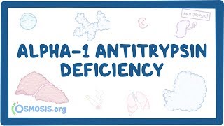 Alpha1 Antitrypsin Deficiency  causes symptoms diagnosis treatment pathology [upl. by Ardnuahc927]