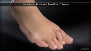 Hammertoe Repair with RetroFusion™ Implant [upl. by Fried]