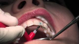 Composite Fillings [upl. by Keil]