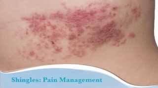 Shingles Explained by Top Pain Doctor in Las Vegas Nevada [upl. by Uriisa]