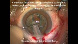 iH during phacoemulsification cataract surgery  ID 124528 [upl. by Procter738]