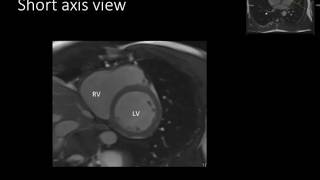 Pathophysiology of Myasthenia Gravis [upl. by Fattal]