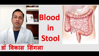 Reason for Blood in Stool  Causes and Treatment in Hindi [upl. by Amzu]