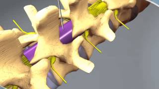 Basic neuroradiology procedures part 2  Lumbar puncture [upl. by Nairod]