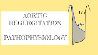 Aortic Regurgitation Insufficiency Explained Clearly [upl. by Euk]