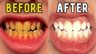 How I Whitened My Teeth in 14 Days [upl. by Cummine]