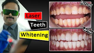 Teeth Whitening With Laser  Fastest amp Safest way [upl. by Kenison]