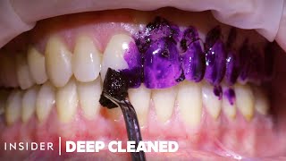 How Teeth Are Professionally Deep Cleaned  Deep Cleaned [upl. by Lahcim216]