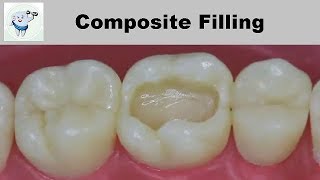 Composite Dental Filling Step by Step [upl. by Jacinto]