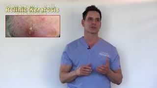 PreCancers or Actinic Keratosis Treatment Options With Dr Timothy Jochen [upl. by Latonia790]