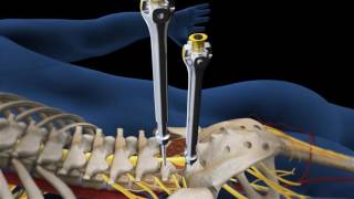 Lumbar Fusion of L5 S1 Animation [upl. by Ause917]