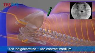 Treatment of herniated disc with TESSYS method lateral  BandscheibenOP mit TESSYSMethode lateral [upl. by Onilatac904]