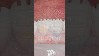 MINIMALLY INVASIVE  Depth measurements in composite mockup dentist composite veneers [upl. by Airyt]