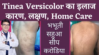 Tinea Versicolar Treatment  भभूतीसीपसहुआकरोडिया का इलाज  Pityriasis Versicolor  In Hindi [upl. by Anoet]