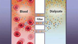 Hemodialysis and how it works  IKAN ch6  old vrs [upl. by Leidba]