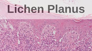 Lichen Planus  Pathology mini tutorial [upl. by Suolhcin]