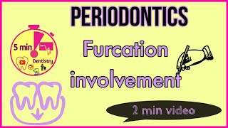 FURCATION INVOLVEMENT  Glickmans classification in 2 minutes  Periodontics [upl. by Sloatman]