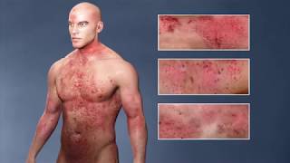 Atopic Dermatitis eczema From the Inside Out [upl. by Neyud391]