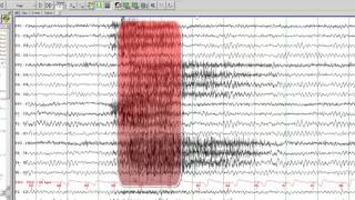 Understanding Infantile Spasms  Symptoms Diagnosis amp Research [upl. by Hgielac]