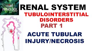 ACUTE TUBULAR INJURYNECROSIS or ACUTE KIDNEY INJURY  Pathology [upl. by Sluiter]