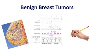 Benign Breast Conditions  USMLE COMLEX NCLEX [upl. by Scopp64]