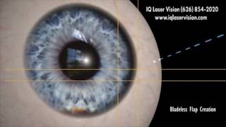 PreOp® Patient Education Lasik Laser Eye Surgery [upl. by Gian]