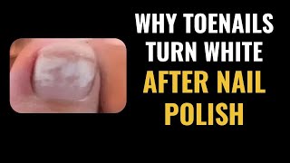 WHITE Toenails after Nail Polish  QUICK TREATMENT FROM PODIATRIST [upl. by Klusek]