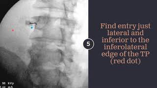 Fluoroscopic Intraarticular Hip Injection [upl. by Nevur]