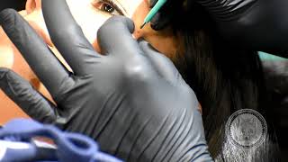 MicroDermal Procedure [upl. by Yeliab173]