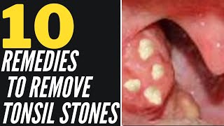 How To Remove Tonsil Stones Naturally 10 Home Remedies That Work [upl. by Bainter]