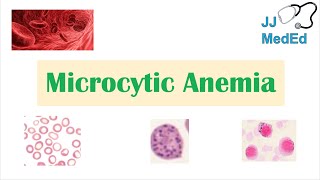 Microcytic Anemia amp Causes Iron Deficiency Thalassemia Anemia of Chronic Disease Lead Poisoning [upl. by Nerahs]