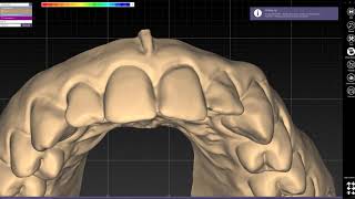 EXOCAD  How to design a waxup model [upl. by Eixirt]