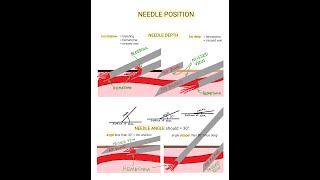 Venipuncture  How to Position a Needle [upl. by Hernardo]