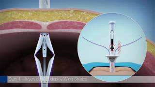 Weck® EFx Shield® Fascial Closure System  Overview Animation [upl. by Eixela377]